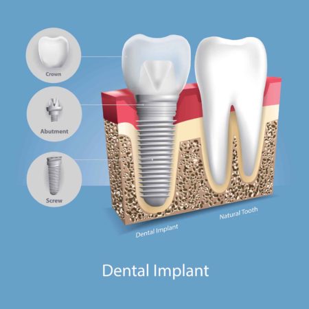 Illustration of the three components of a dental implant