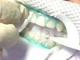 Photo of a patient's mouth prepped for whitening gel treatment with retracted lips and a protective towel. 
