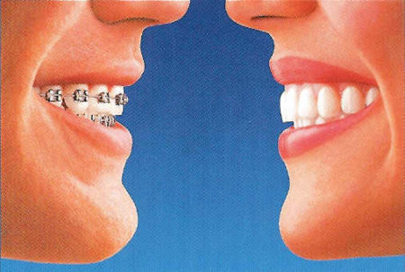 An image showing two people's mouths, facing each other. One has metal brackets and wires on the teeth. The other has a clear, invisible aligner on the teeth.