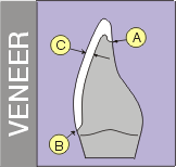 Cross section diagram of a dental veneer on a front tooth, showing a thin veneer overlaying the front of the tooth.