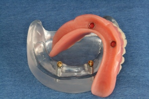 A photo of a clear plastic model of a lower jaw with two implant fixtures in the front, and a denture that can be snapped over the implants, making the procedure affordable.