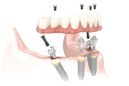An illustration of an all-on-four denture. The image shows four implants placed in the lower jaw with an implant overdenture ready to be placed.