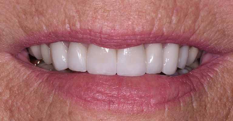 smile gallery teeth after