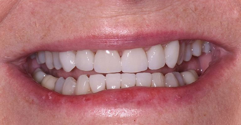 smile gallery teeth after