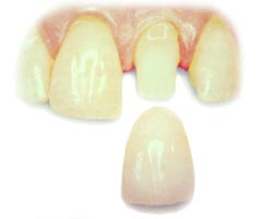 An image of a porcelain crown positioned to be placed over a prepared upper front tooth