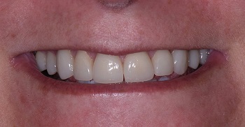 a closeup of a patient's beautiful, natural smile after full-mouth reconstruction
