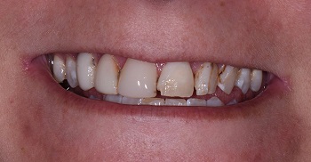 a closeup of a patient's mouth with teeth stained and uneven before full-mouth reconstruction