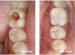 before and after images of a prepared cavity filled with white composite by a mercury-free dentist