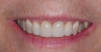 A close-up photo of a patient's teeth with porcelain crowns on her two front teeth, which match her other teeth perfectly