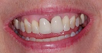 An up-close photo of a patient's teeth with noticeable porcelain-fused-to-metal crowns on her two front teeth. This picture is before her all-porcelain crowns.