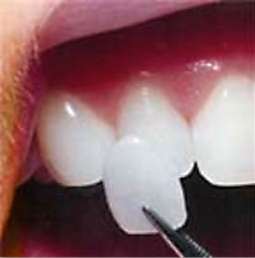 A porcelain veneer wafer being held up to a tooth
