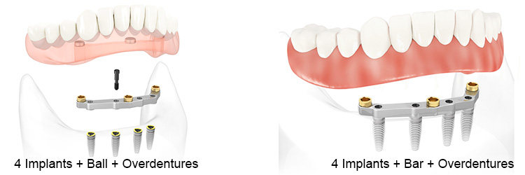 An image showing a diagram of ball-retained dentures and bar-retained dentures