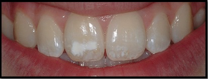 Teeth with mild hypoplasia
