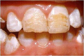 teeth with severe hypoplasia