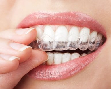 Teeth whitening trays being placed on someone's teeth. 