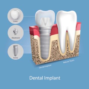 Dental implant next to a natural tooth