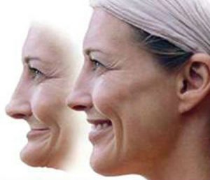 An image of a woman's face both before and after facial collapse.