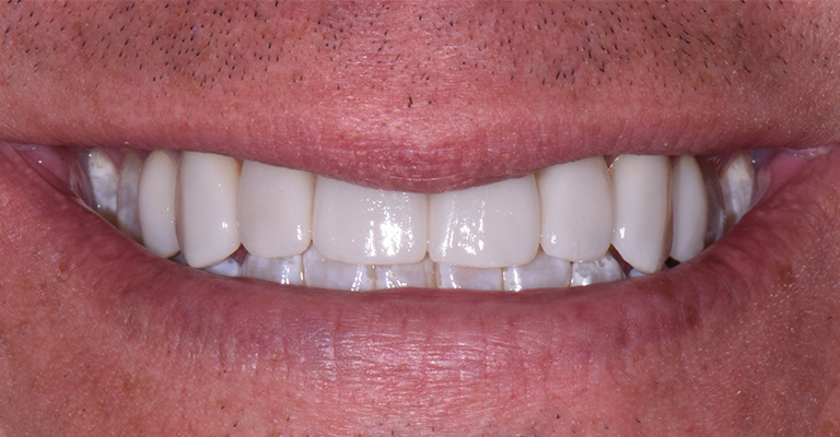 smile gallery teeth after