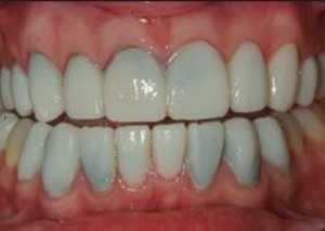 porcelain veneers  with a bluish tint. 