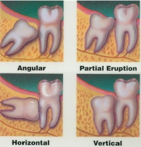 Impacted wisdom teeth